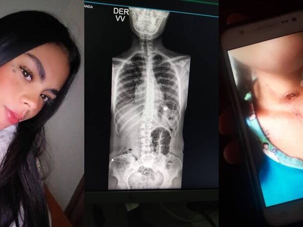 Vivir con la ‘prueba reina’ en el cuerpo: mujer que sobrevive con una bala en el pulmón busca condena contra la Policía | Cambio Colombia