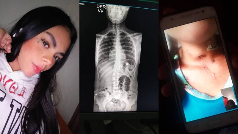 Vivir con la ‘prueba reina’ en el cuerpo: mujer que sobrevive con una bala en el pulmón busca condena contra la Policía | Cambio Colombia